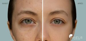 Résultat avant après d'une femme ayant réalisée un soin hydrafacial