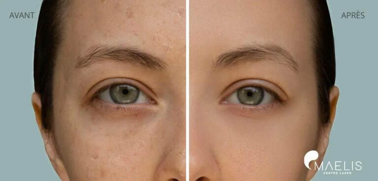Résultat avant après d'une femme ayant réalisée un soin hydrafacial