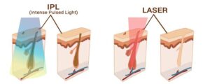 Reconstitution visuel de la différence de technique d'élimination du poil entre l'IPL et du Laser