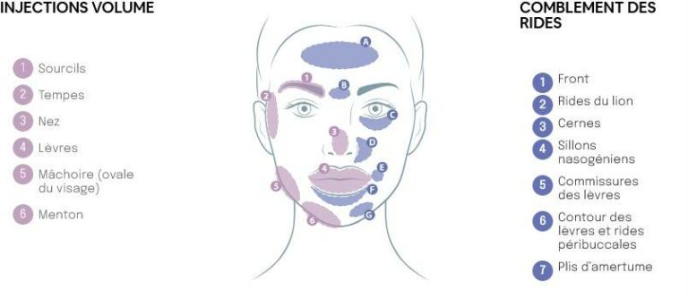 Zones d’injection d’acide hyaluronique réalisé chez Maelis centre laser pour le comblement des rides du visage et la restauration des volumes : front, sillons nasogéniens, cernes, lèvres, menton, mâchoire